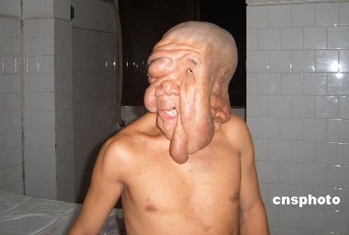 amystery.bf_1.com_wp_content_uploads_2009_09_elephant_man_huang_chuncai1.jpg