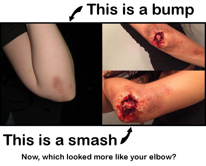 elbow-bruise.jpg