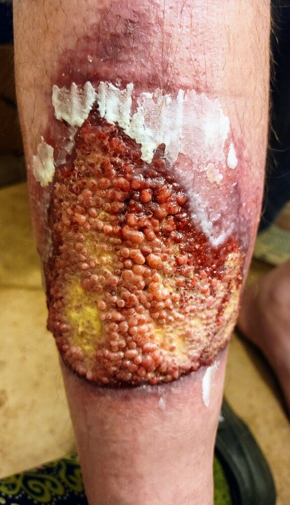 leg burns2.jpeg