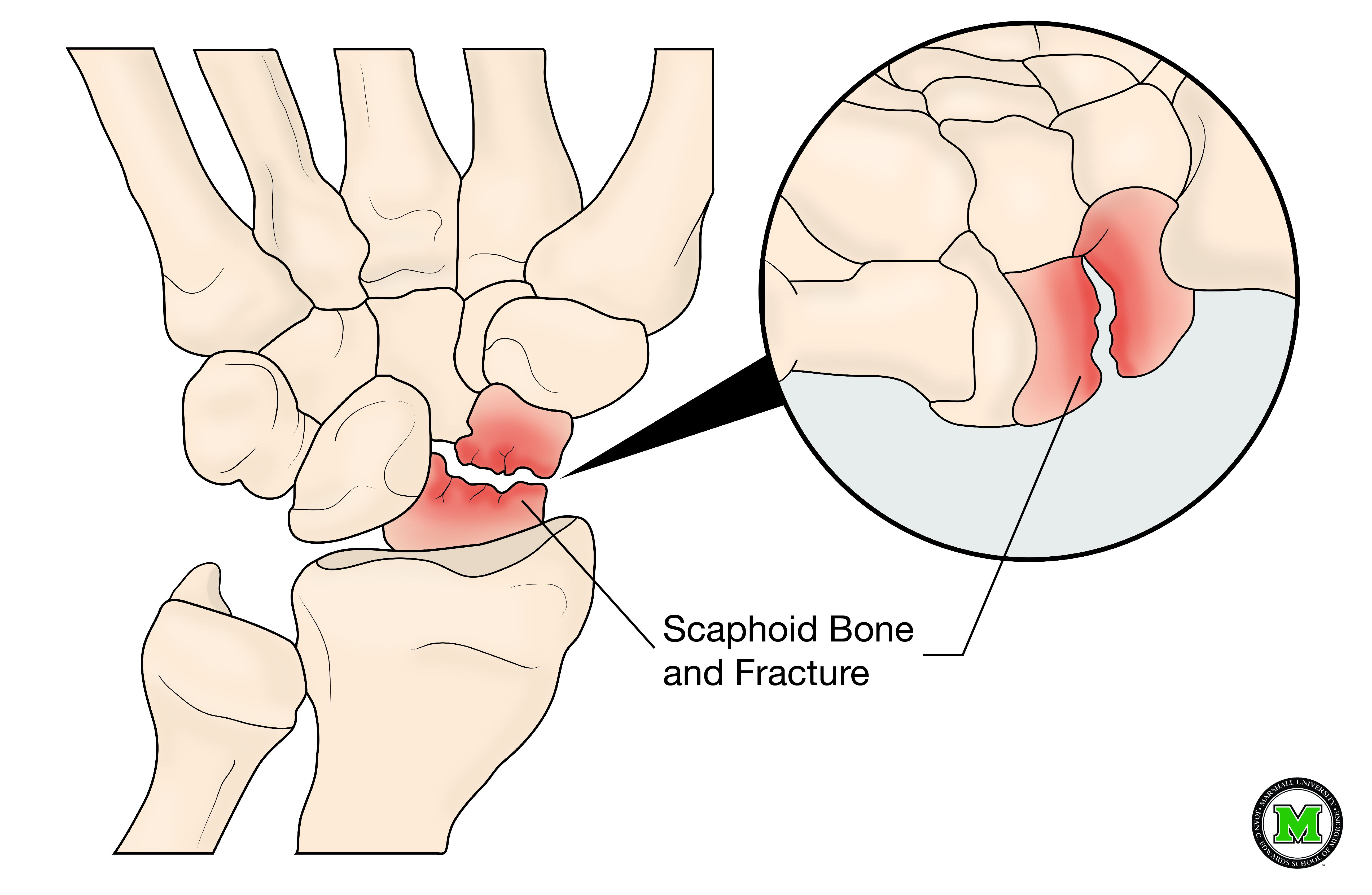 Scaphoid-Fracture-MU.jpg